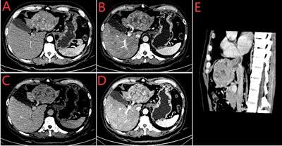 Immune Checkpoint Inhibitor-Based Systemic Therapy Shows Remarkable Curative Effect in a Hepatocellular Carcinoma Patient With Intractable Postoperative Recurrence and Metastases: A Case Report and Literature Review